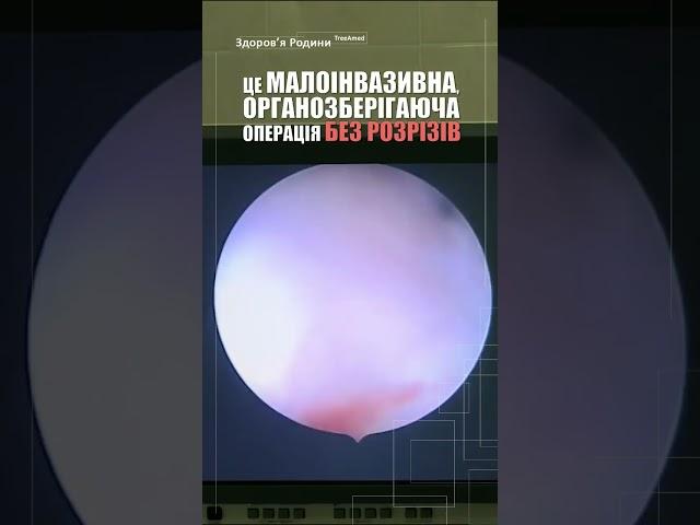 Гістероскопiчний метод видалення міоми. Малоінвазивна, органозберігаюча операція без розрізів.