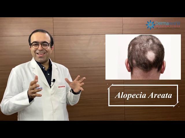 ALOPECIA AREATA Symptoms, Causes & Treatments | Dr Rohit Batra | Permanent Cure