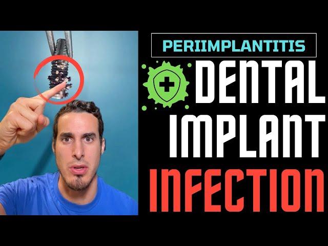 If you wear DENTAL IMPLANTS you should WATCH THIS - Dental Implant INFECTION or PERIIMPLANTITIS