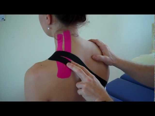 How to treat Neck pain - Levator Scapulae / Upper Trapezius Strain using Kinesiology Tape