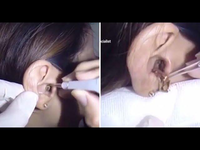 耳掃除の難聴 最大の耳垢除去 | #T7H1234