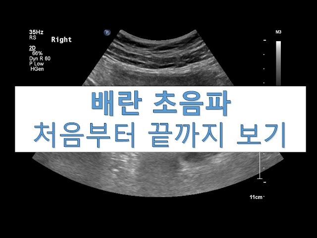 배란 초음파 처음부터 끝까지 보기 l 모두 임신준비 화이팅 