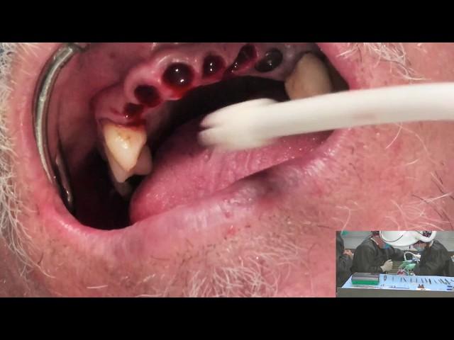 Immediate Ceramic Dental Implants in the Anterior Region