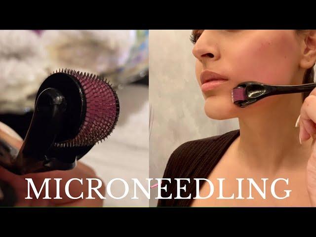 MICRONEEDLING AT HOME | How I Healed My Post Acne Scars Quickly