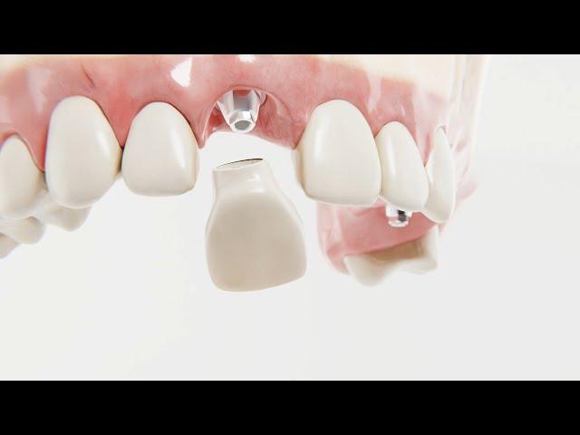 Introducing DIO Multiunit Abutment