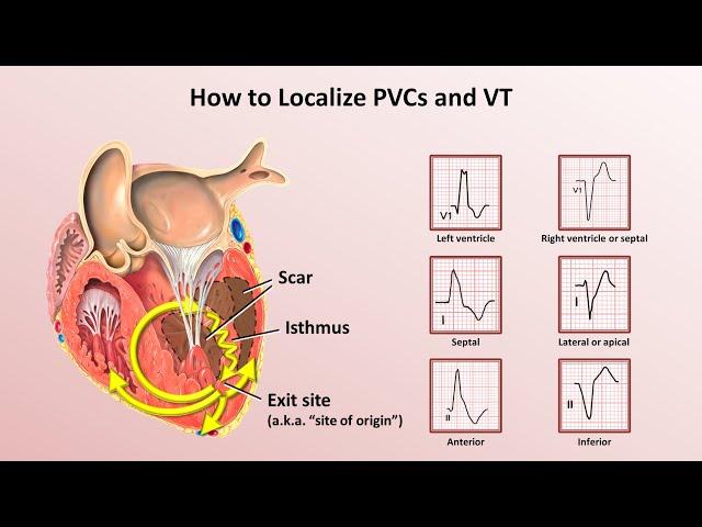 Advanced EKGs - Ventricular Tachycardia (Classification & Localization)