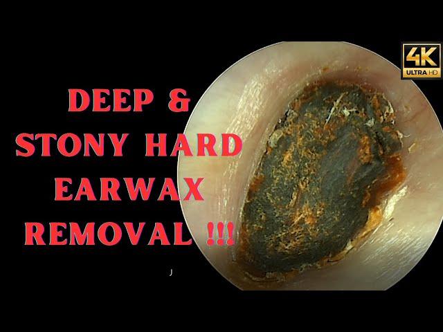 DEEP & Stony HARD Earwax Removal (Very Satisfying Video)