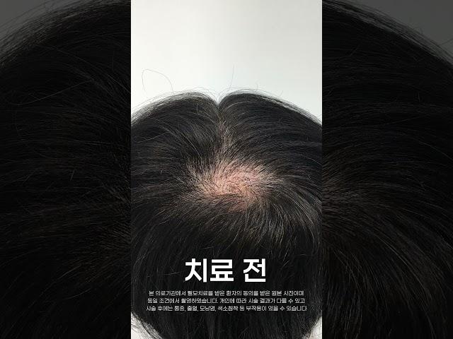 M자, 정수리 탈모치료 11회차 전후