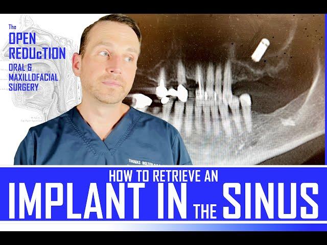 DENTAL IMPLANT FALLS INTO the SINUS | HOW TO RETRIEVE with CALDWELL LUC APPROACH | OMFS