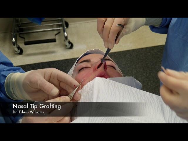 Tip Grafting in Rhinoplasty by Using the Endonasal or Closed Approach.