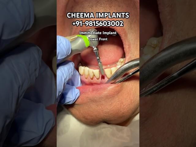 Dental Implant Surgery procedure incisor extraction implant drilling implant placed #dentalimplants