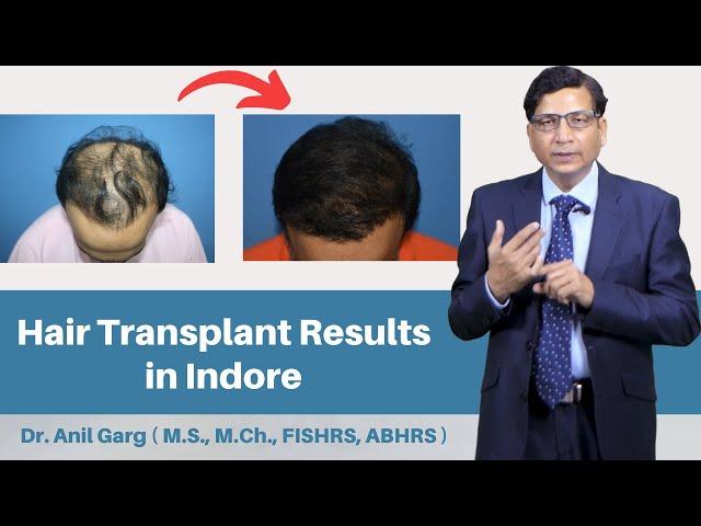 Indore Best Hair Transplant Clinic | Hair Transplant in Indore ( Cost & Result ) Dr. Anil Garg