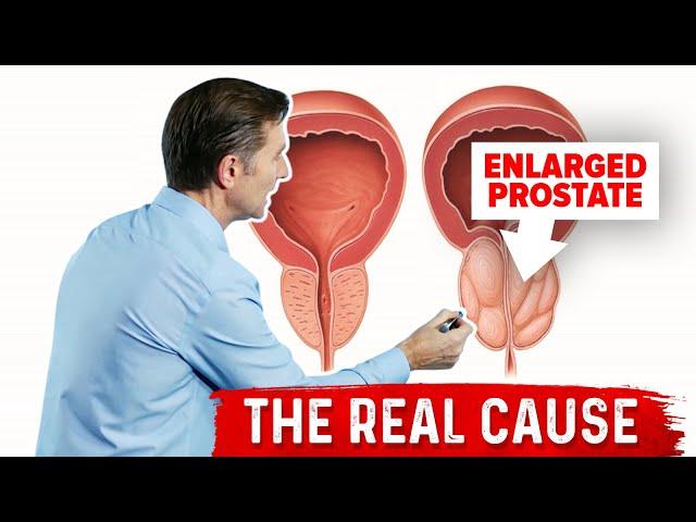 Enlarged Prostate and Urination Problems Explained by Dr.Berg