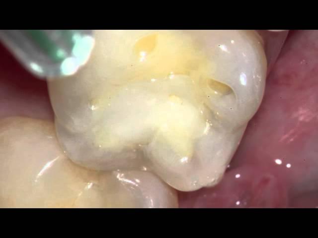 Long lasting tooth colored fillings - Five year old composite fillings