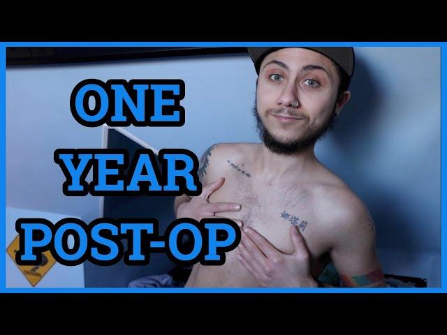 ONE YEAR POST-OP TOP SURGERY WITH MILES BERRY (FTM) | STEPH KYRIACOU