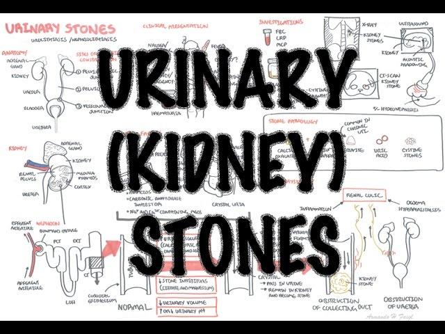 Urinary/Kidney Stones - Overview (signs and symptoms, risk factors, pathophysiology, treatment)