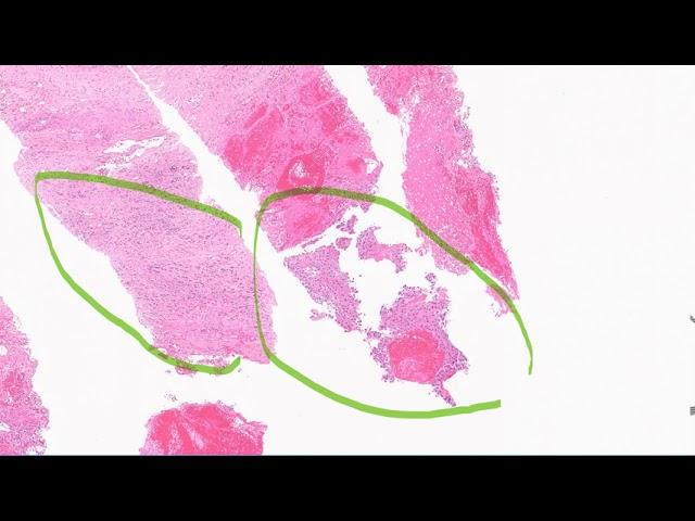 Well differentiated hepatocellular carcinoma vs benign hepatic proliferation