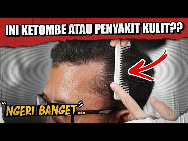 WADUH.! KULIT KEPALA BANYAK KETOMBE KOK BISA? BEGINI CARA MENGATASINYA.!