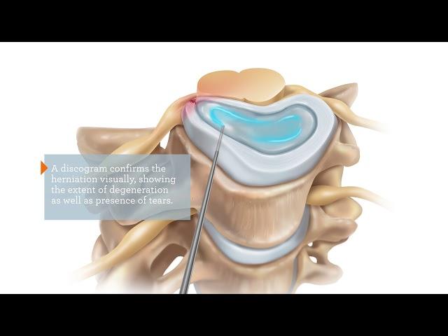 IntelliSpine Cervical Laser Procedure