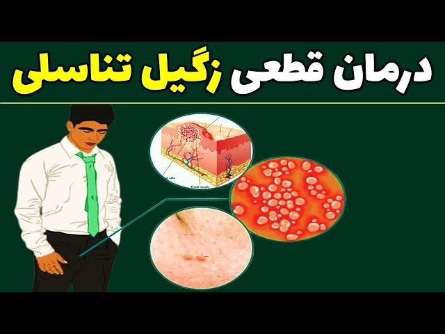 چگونه زگیل تناسلی را از بین ببریم؟| درمان زگیل تناسلی در خانه | درمان خانگی زگیل تناسلی