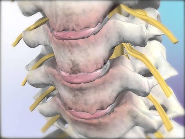 Cervical Spondylosis: Learn@Visible Body