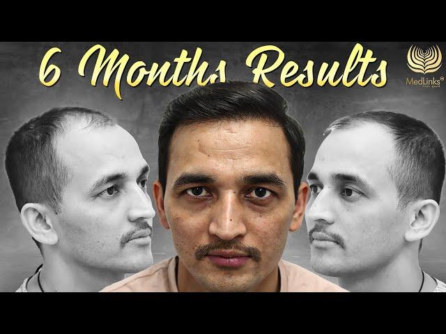 Best Hair Transplant Results in Grade 3 | Hair Transplant Surgery Month by Month Results in Delhi