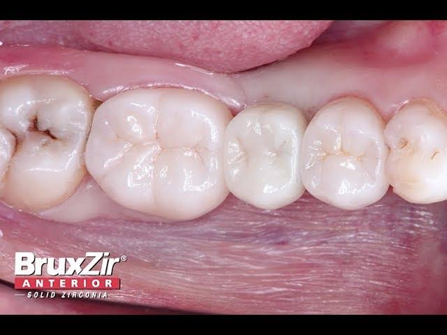 Chairside Live Episode 223: Protocol for Single-Tooth Implant Placement