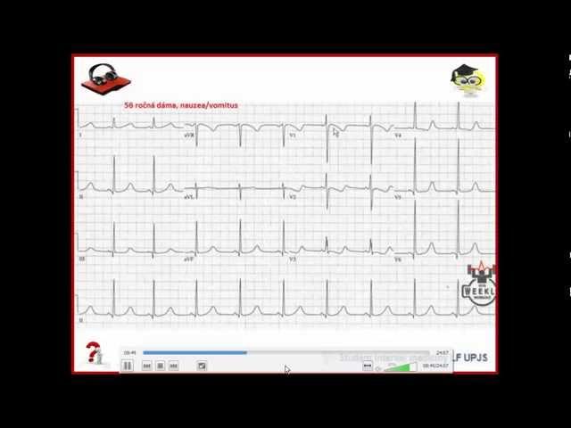 Ecg Podcast 12 of 56  Kazuistika, pani s hornou dyspepsiou