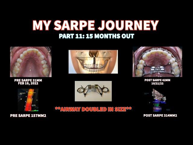 MY SARPE JOURNEY PART 11: 15 MONTHS OUT