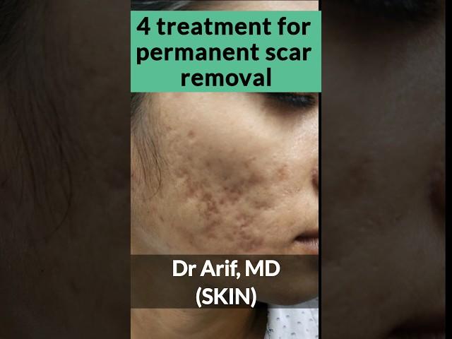 4 treatment for acne scar removal @DrArifMDDermatologist #acnescars #acnescartreatment