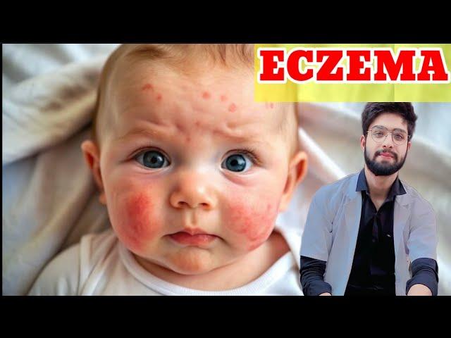 Eczema (एक्जिमा): Causes, Symptoms & Types | Atopic & Seborrheic Dermatitis Symptoms #facts