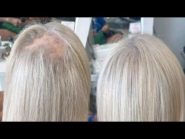 V-light hair extensions| alopecia / hair thinning~ hair extensions transformation