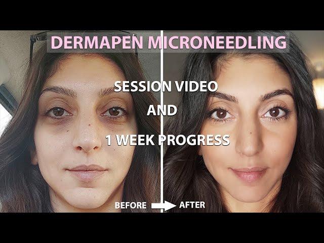 Dermapen Microneedling Before And After | Process + 1 Week Amazing Results