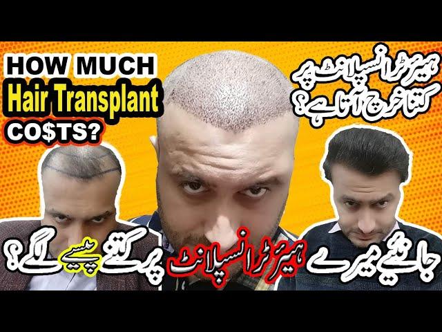 Total Hair Transplant Cost | Hair Transplant price in Pakistan | hair Transplant in Pakistan |