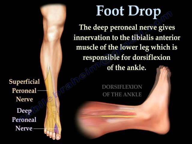 Foot Drop, Peroneal Nerve Injury - Everything You Need To Know - Dr. Nabil Ebraheim