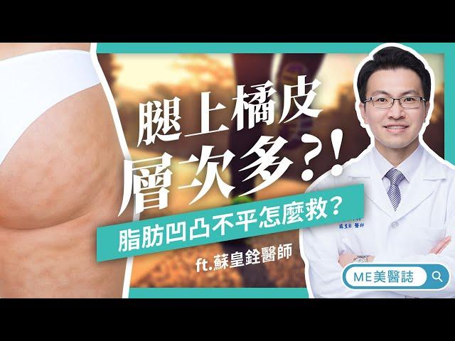 抽脂｜橘皮上身好沮喪？ 脂肪凹凸不平怎麼救？ft.整形外科蘇皇銓醫師【ME美醫誌】