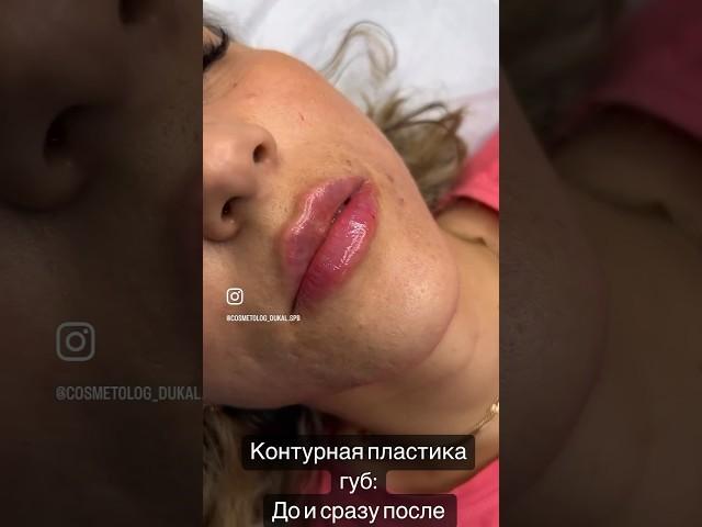 Губы - Чайка ?! Как исправить …. До и сразу после контурной пластики #губы #beauty #косметолог