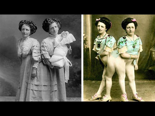Единственные сиамские сестры-близнецы которые родили ребёнка! История сестёр Блажек