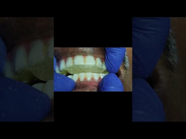 Anterior deprogrammer for full arch implant prosthesis! ##shorts
