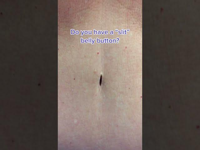 Slit Belly Button? #shorts #tummytuck