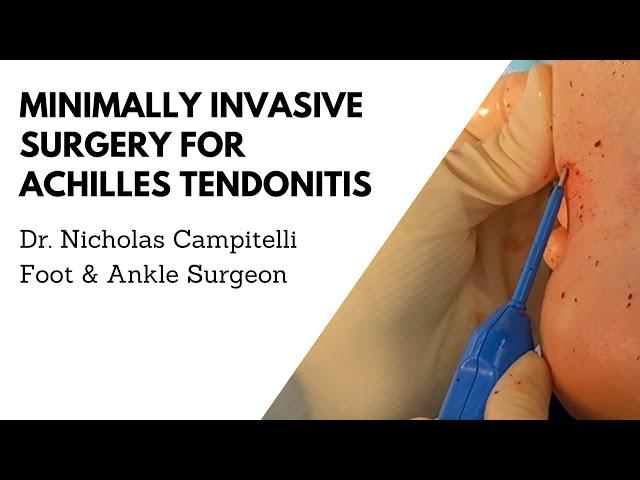 Achilles Tendonitis Treatment with Surgical Debridement Using TenJet| Dr. Nicholas A. Campitelli