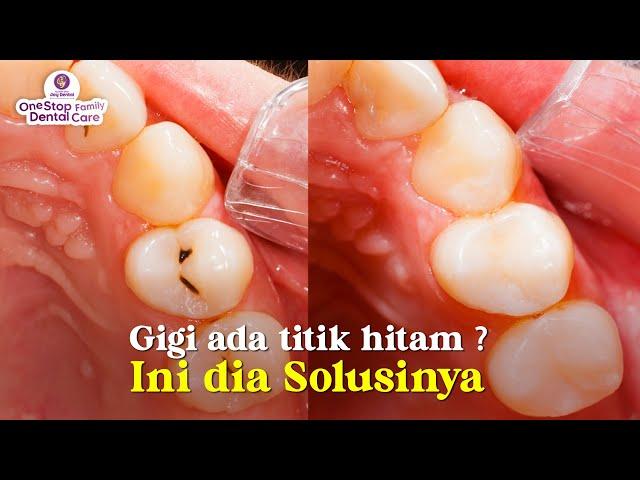 LUBANG GIGI KECIL TAPI DIDALAMNYA TERNYATA BESAR l SOLUSINYA APA YA ?