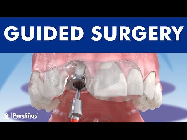 Guided implant surgery ©