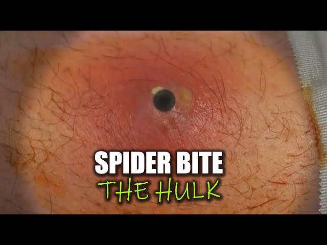 Texas' Worst Spider Bite, Hulk's Aftermath -#3 Top Ten All Time