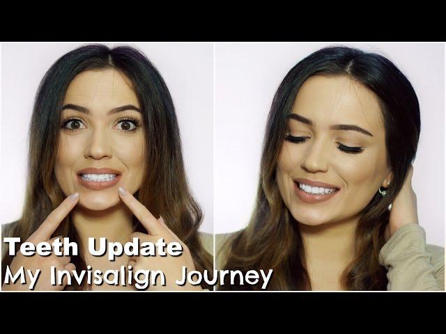 Invisalign Update Journey | More Refinements