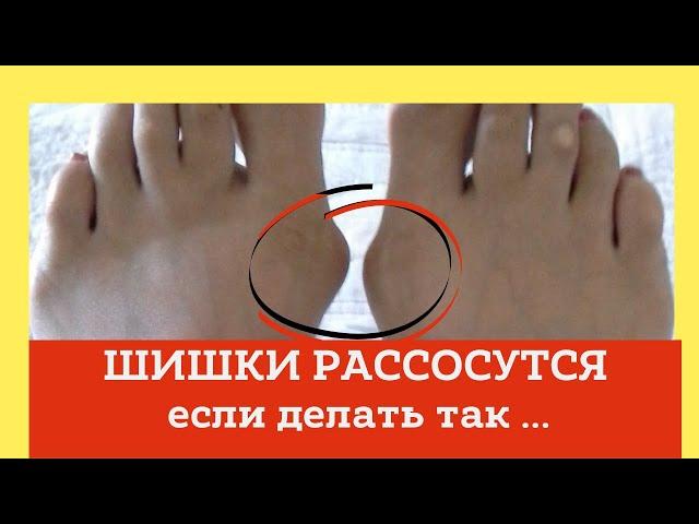 Шишки на больших пальцах рассосутся если делать это... Домашний лечебник
