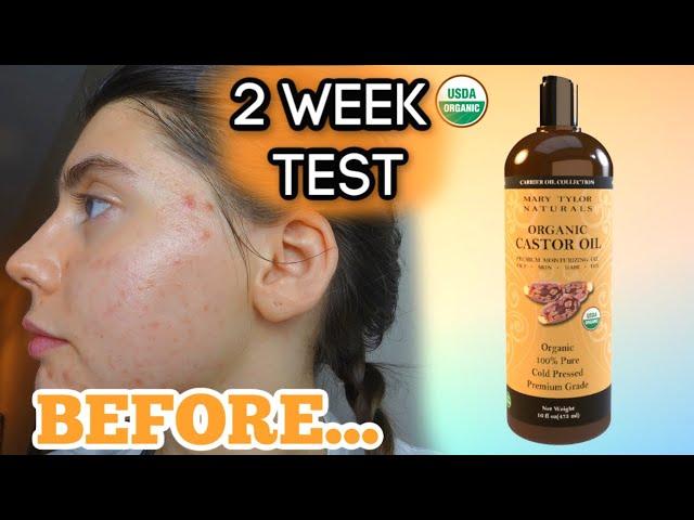 I TESTED PURE CASTOR OIL ON MY FACE FOR MY ACNE SCARS FOR 2 WEEKS || My review and thoughts!