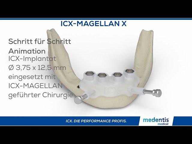 ICX Magellan X® geführte Implantation animiert!