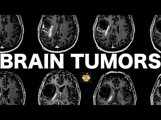 Brain Tumors