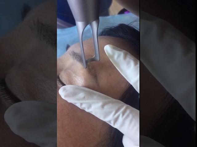 Eye brow removal--Nd Yag Laser ~Naomi